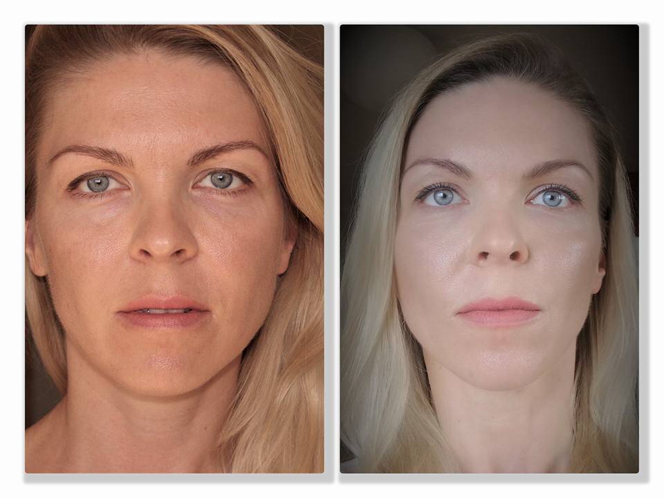 Before After pictures