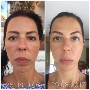 FACIAL YOGA BEFORE AND AFTER