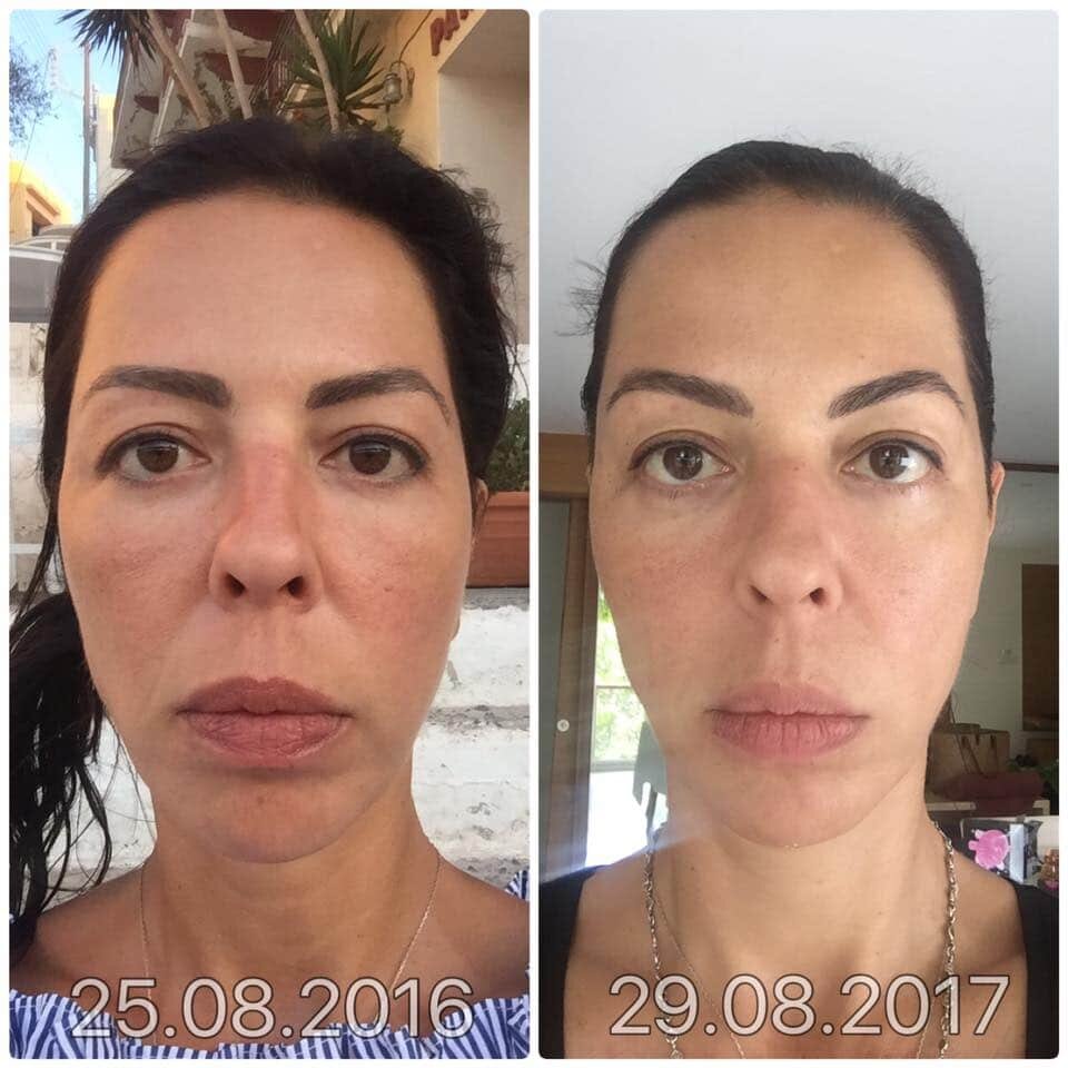 Before and after