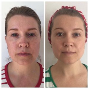 Before and after face yoga