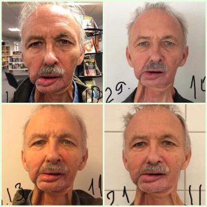 Face Yoga and rehabilitation 2 Face Yoga and rehabilitation 1