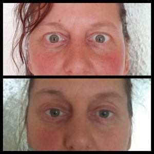 FACIAL YOGA BEFORE AND AFTER