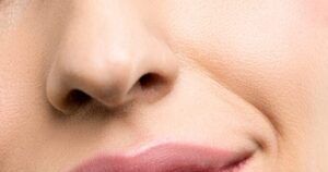 Nazolabijalne bore 1 Nasolabial folds