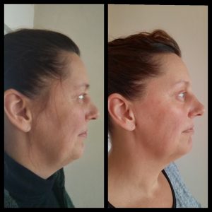 FACIAL YOGA BEFORE AND AFTER