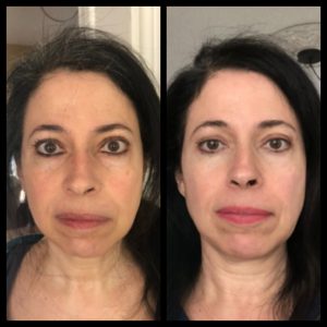 Before and after 19 Before and after eyes