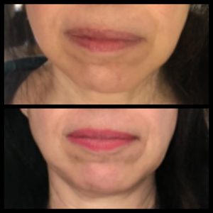 Before and after face yoga